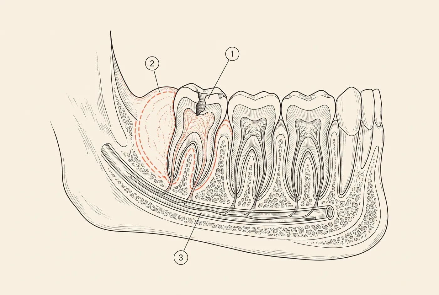 Illustration technique : coupe d’une mâchoire inférieure avec une molaire cariée, un gonflement et le nerf alvéolaire